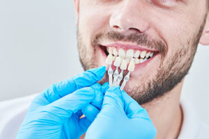 dental veneers tx, veneers held up to bearded man's teeth