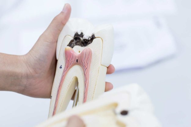 tooth decay Tooth Decay