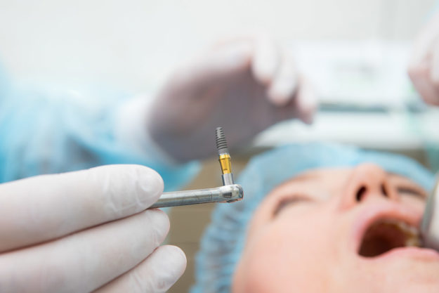 what are dental implants (1) Patient Receiving Dental Implant