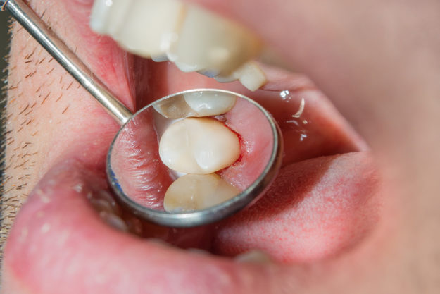 a doctor explaining dental sealants
