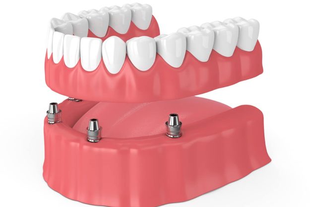 a model of permanent dentures