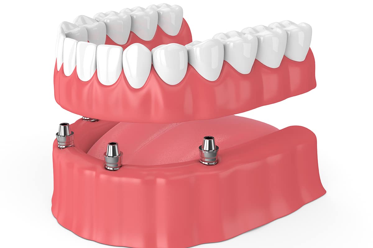 a model of permanent dentures