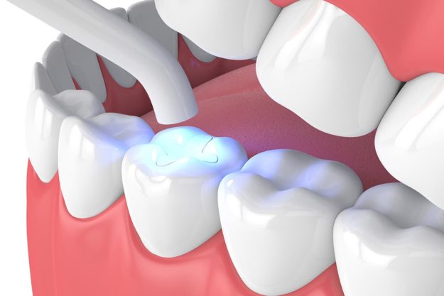 a model of a cavity filling