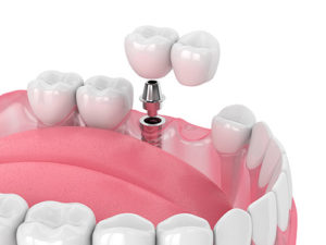 a model shows dental implant options before a dental implant procedure