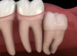 an image of wisdom teeth in need of oral surgery and specialty dentistry services