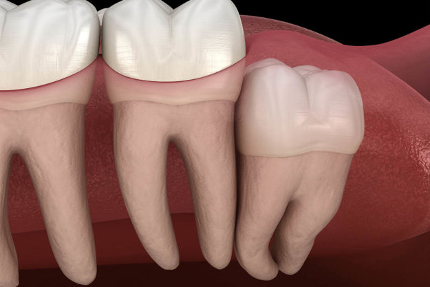 wisdom-teeth an image of wisdom teeth in need of oral surgery and specialty dentistry services