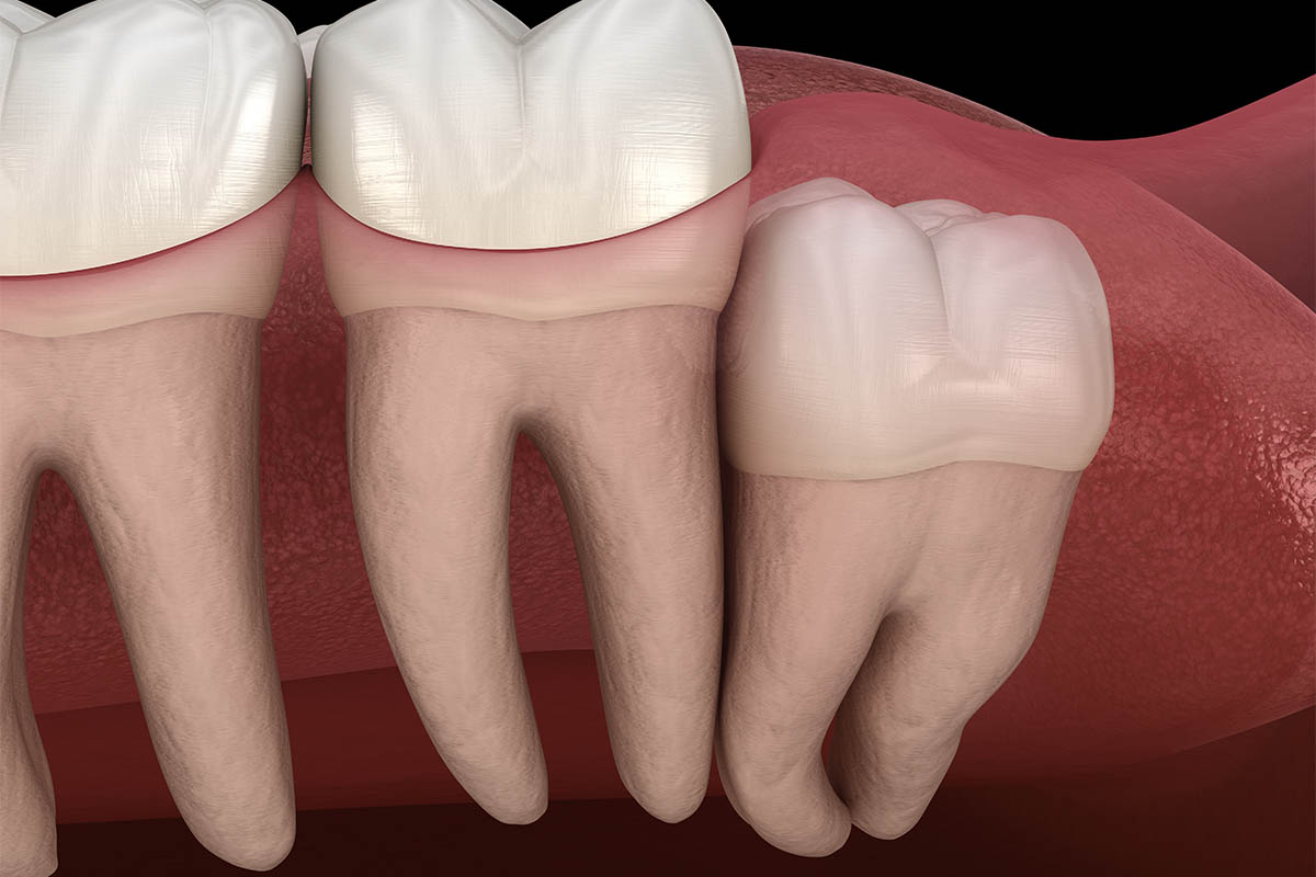 an image of wisdom teeth in need of oral surgery and specialty dentistry services