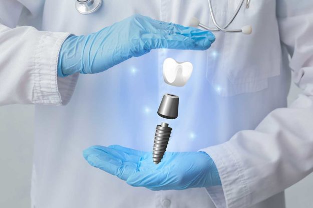 3-What-is-a-Single-Tooth-Implant example of single tooth implant