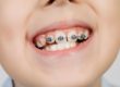 child getting braces for kids