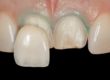 example of dental veneers being place