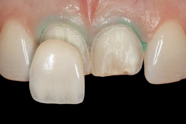 5 Benefits of Dental Veneers example of dental veneers being place