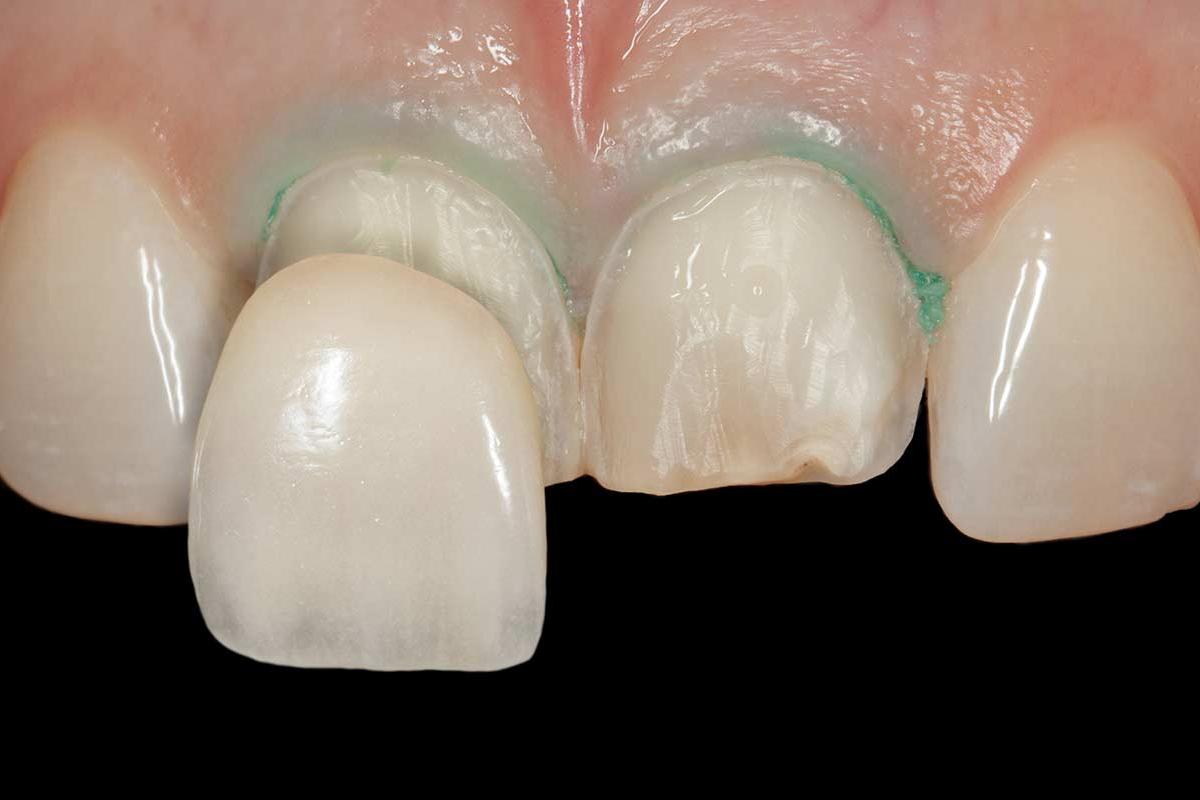 5 Benefits of Dental Veneers Cosmetic Dental Services Houston TX