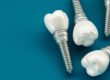 examples of dental implants