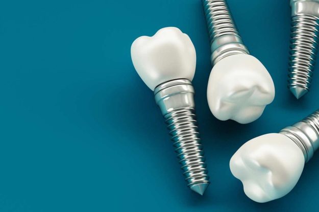 How Do Dental Implants Work (1) examples of dental implants